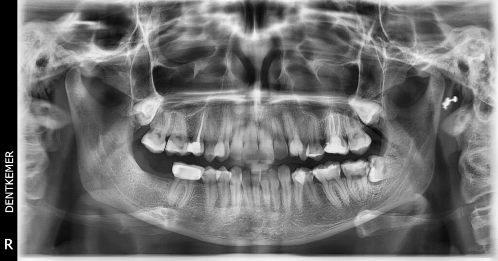 Impacted Tooth Surgery – DentKemer